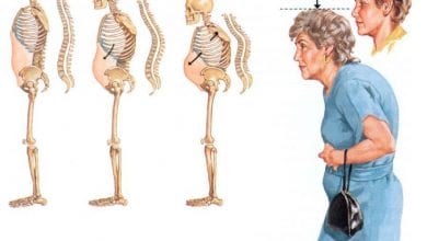 Photo of ما هي أنواع هشاشة العظام وأعراضها