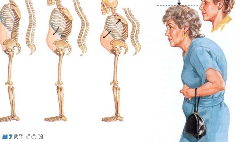 أنواع هشاشة العظام