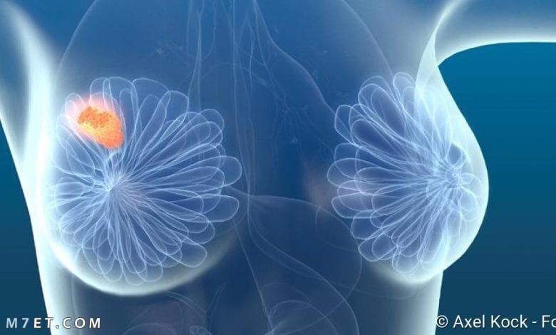 اعراض سرطان الثدي الحميد
