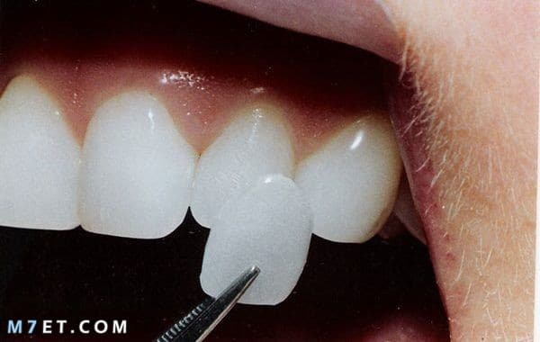 ما هو لومينير الأسنان ؟...وما ميزاته وأسباب تركبيه صورة رقم 1