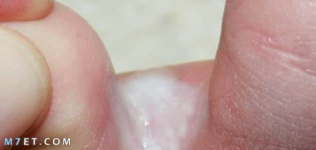 أسباب وعلاج الفطريات بين أصابع القدم..هكذا تتخلص منها صورة رقم 1