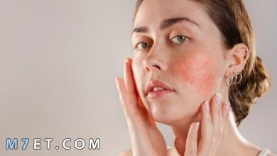 Photo of 7 اسباب حساسية الوجه| طرق العلاج الطبيعية في المنزل