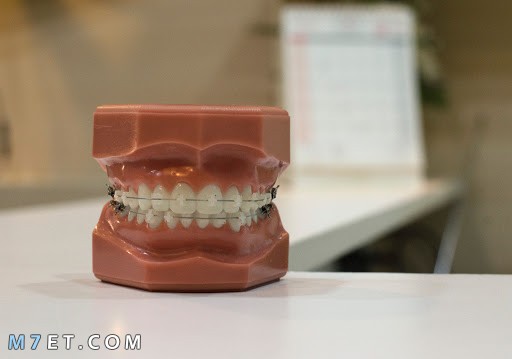 تقويم الأسنان | فوائد واستخدامات
