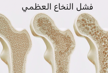 Photo of أعراض فشل النخاع العظمي وأشهر 7 طرق للعلاج