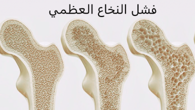 Photo of أعراض فشل النخاع العظمي وأشهر 7 طرق للعلاج