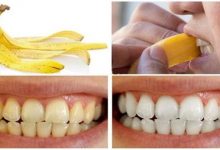 Photo of فوائد قشر الموز لتبييض الاسنان خلال دقائق