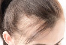 Photo of علاج تساقط الشعر عند النساء بـ 4 طرق طبيعية
