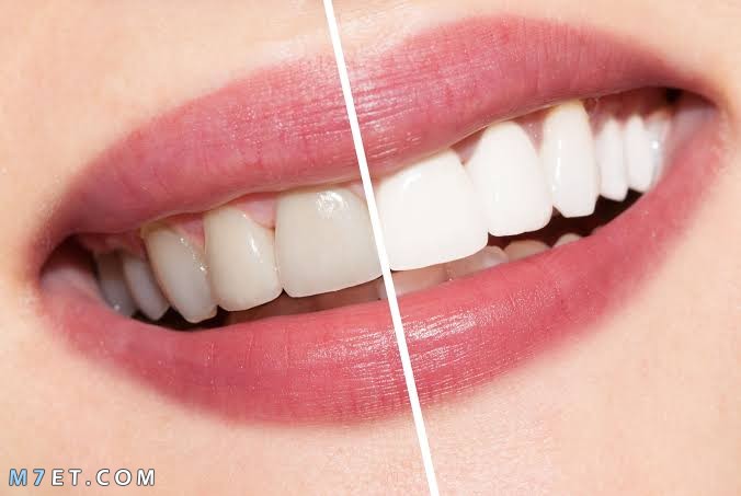كيفية جعل الاسنان بيضاء