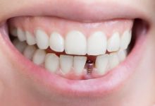 Photo of أنواع تركيبات الأسنان المتنوعة 2024