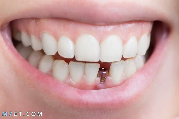 أنواع تركيبات الأسنان المتنوعة 2021