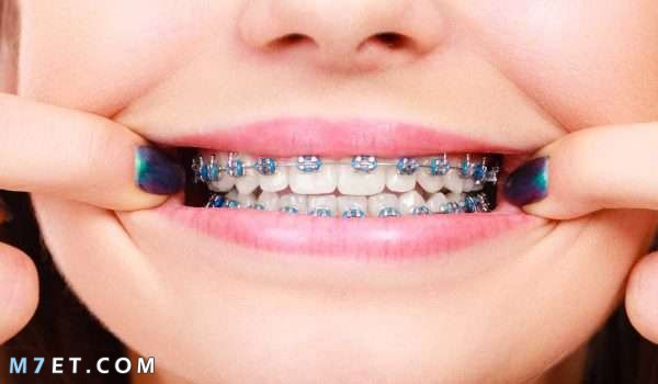 طريقة تركيب تقويم الأسنان