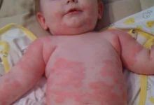 Photo of أهم المعلومات حول حساسية الجلوتين عند الاطفال