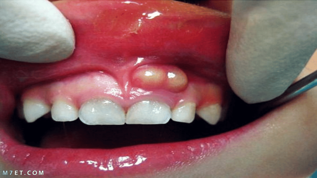 تجارب علاج خراج الأسنان