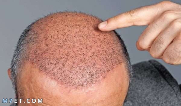 اضرار زراعة الشعر