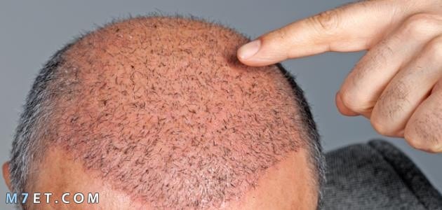 ما هي مخاطر زراعة الشعر