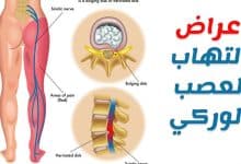 Photo of أعراض العصب الوركي