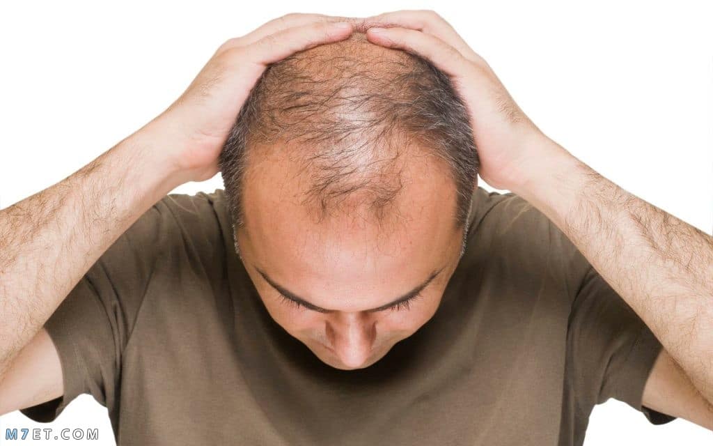 أشهر hair regain لعلاج الصلع وتساقط الشعر