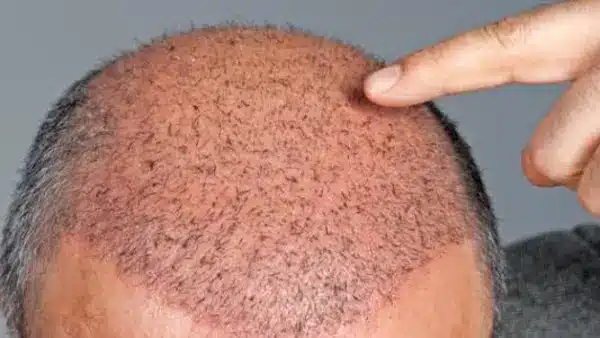 أسعار زراعة الشعر في مصر