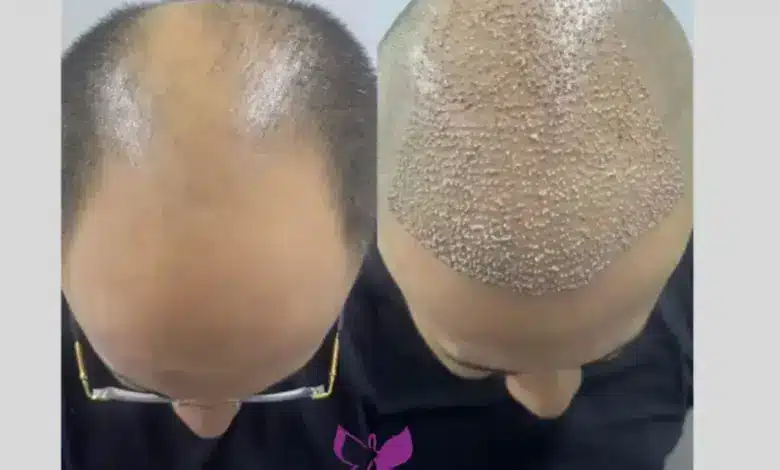 أسعار زراعة الشعر في مصر