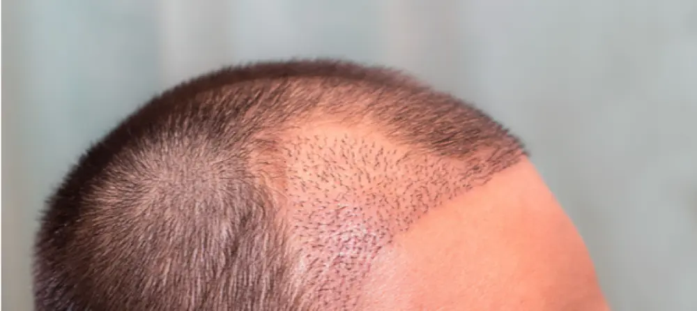 أسعار زراعة الشعر في مصر